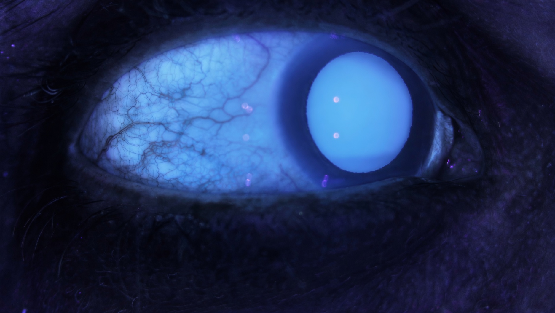 El mismo ojo bajo UV-A: pequeña área de fluorescencia conjuntival